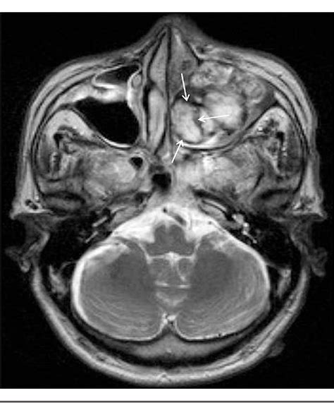 Figure 4 From Hemangioma Of The Maxillary Sinus Presenting As A Mass
