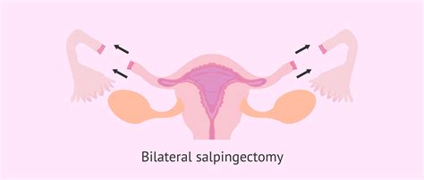 Bilateral Salpingectomy