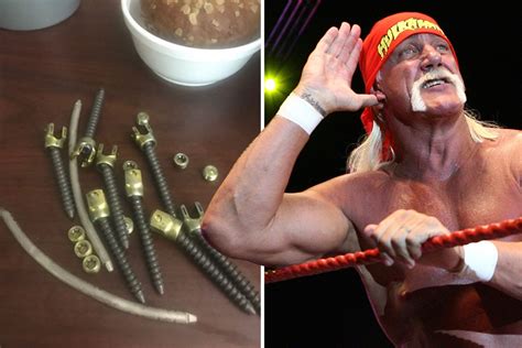 Wwe Legend Hulk Hogan Shares Picture Of Huge Screws He Had In His Back