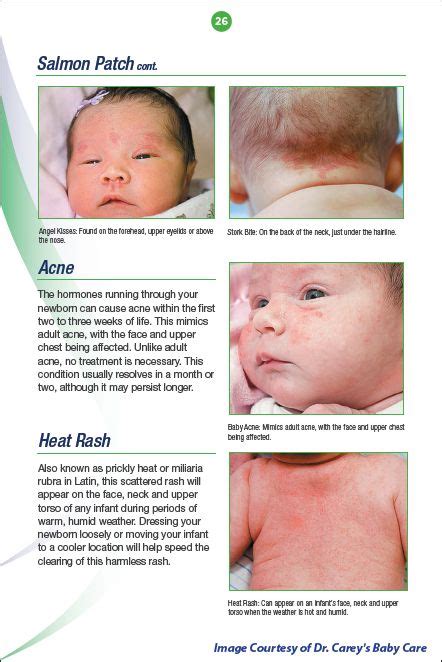 Heat Rash On Baby Back Pictures Heat Rash On Babies Causes