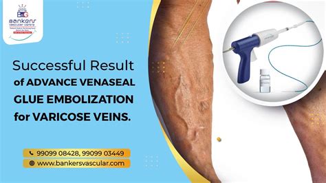 Results Of Varicose Vein Treatment With Venaseal Glue Embolization