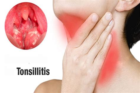 Tonsillitis Condition Care Guide