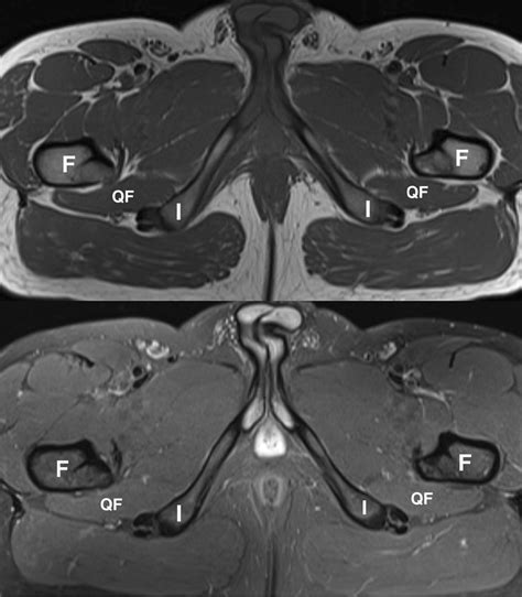 Axial T1 And Stir Images Of The Normal Ischiofemoral Spaces I Ischial