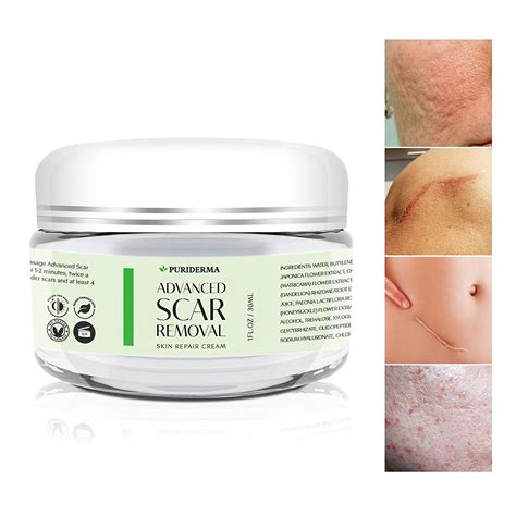 Acne scar removal cream, acne removal cream. Scar Removal Cream - Advanced Treatment for Face & Body ...