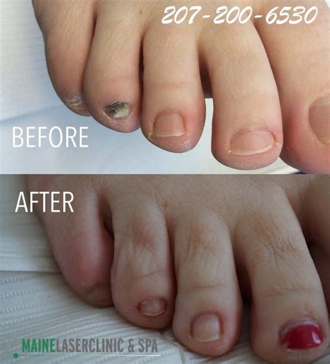 Nail Fungus Before After 207 Laser And Integrative Med