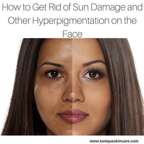 Treating Hyperpigmentation From Sun Damage Exploring Topical Laser And