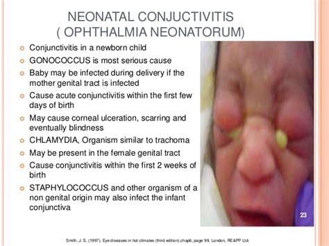 6 Things To Know About Conjunctivitis In Children Pink Eye Page 3