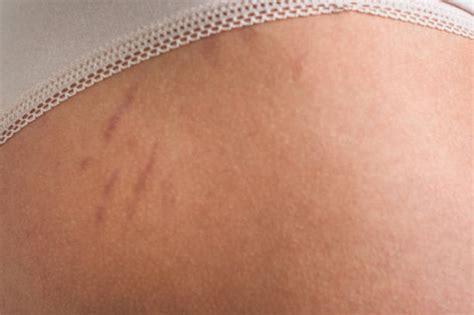 Sores or areas of oozing discharge may develop, too. Buttocks Women Cellulitis Underwear Stock Photos, Pictures ...