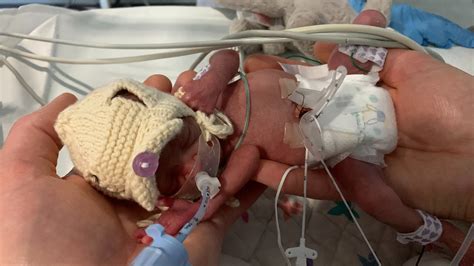 Miracle Baby Born Weighing Less Than Bag Of Sugar And With A Hole In