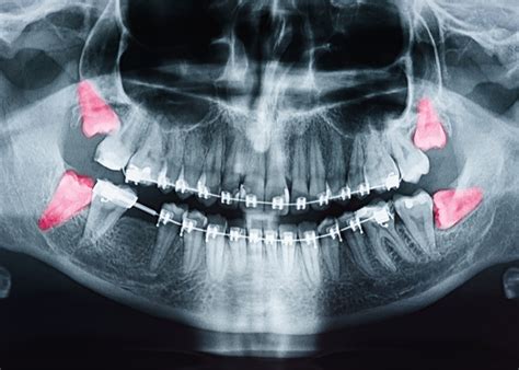 Partially Erupted Wisdom Tooth