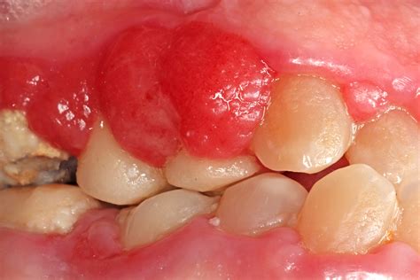 Oral Pyogenic Granuloma