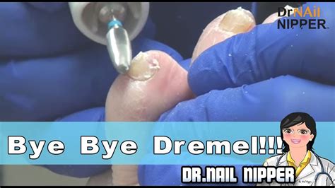 Dremel Tool For Toenail Fungus Nail Ftempo