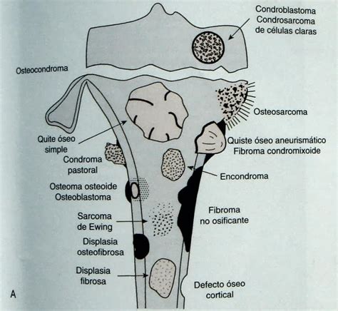 Ortopedia Oncologica Mexico Radiología de lesiones pseudotumorales y