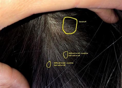 What Do Nits Look Like In Dark Hair Lice Pictures Of What Head Lice