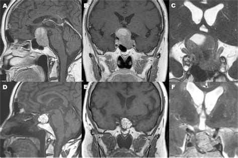 A A Preoperative Mid Sagittal Section Of Gadolinium Enhanced