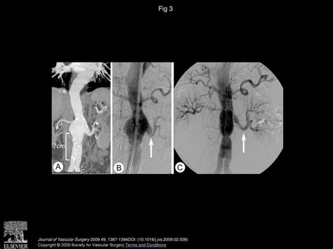 Fenestrated And Branched Endograft Repair Of Juxtarenal Aneurysms After