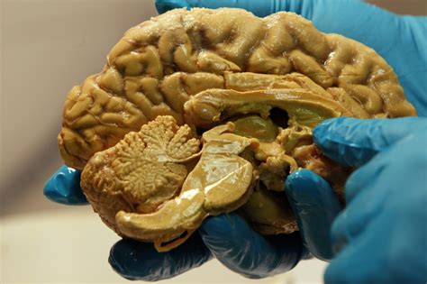 Maybe you would like to learn more about one of these? Chinese woman 24, with no cerebellum 'little brain', leads ...
