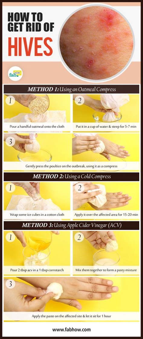 How To Get Rid Of Hives Fast With Home Remedies Fab How