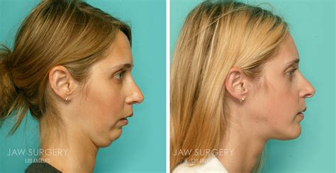 Before And After Photos Los Angeles Ca Jaw Surgery La 2022