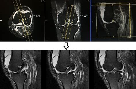Mri Knee Protocol And Planning For Sagittal Anterior Cruciate Ligament