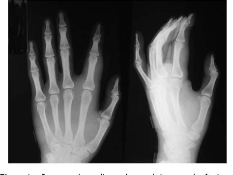 Figure 1 From Surgical Removal Of Radiographically Occult Polyurethane