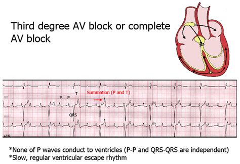 Complete heart block is the most serious type of av heart block. FIREFIGHTER/PARAMEDIC STORIES: Heart Rhythms Part 6: Blocks