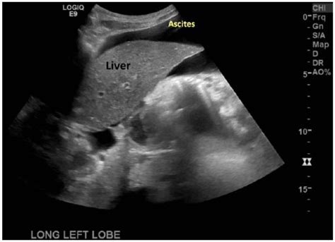 Utilizing Abdominal Sonography In The Diagnosis Of Ascites Caused By