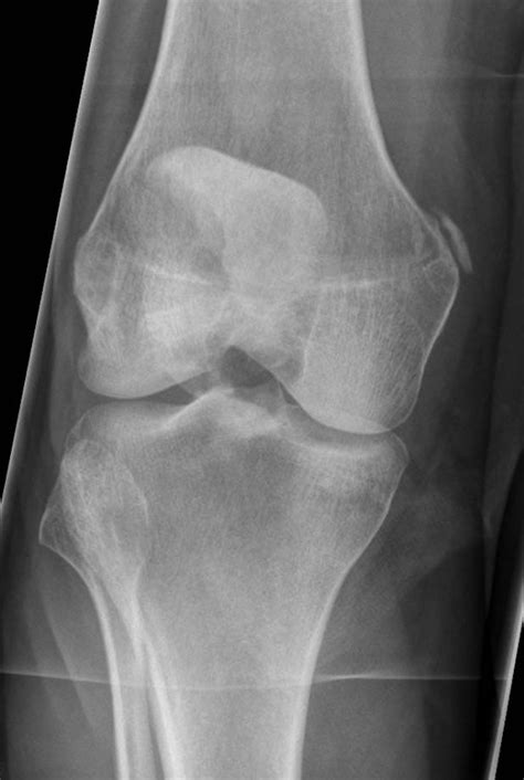 Pellegrini stieda syndrome is the presence of pain and limitations of movement of the knee in the patient with a previous injury to the medial collateral ligament of knee, due to ossification of the. Pellegrini-Stieda syndrome - Wikipedia