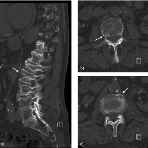 A Sagittal Slice Of The Initial Ct Scan Of The Lumbar Spine A
