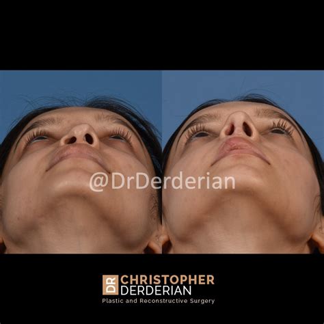 Adult Cleft Rhinoplasty — Dr Derderian — Plastic And Reconstructive Surgery