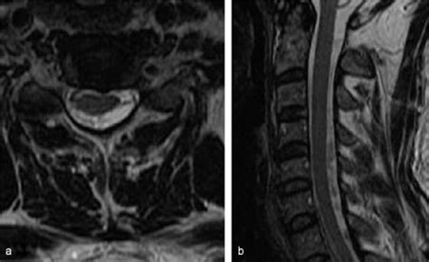 A Axial T2 Weighted Mri Of The Cervical Spine Showing An Intradural