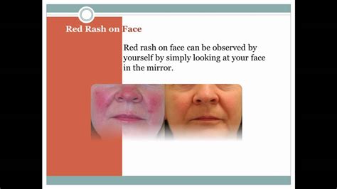 Red Rash On Face Youtube