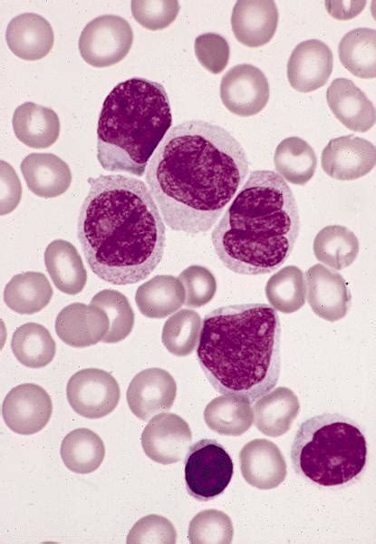 Pathology Outlines Monocytes