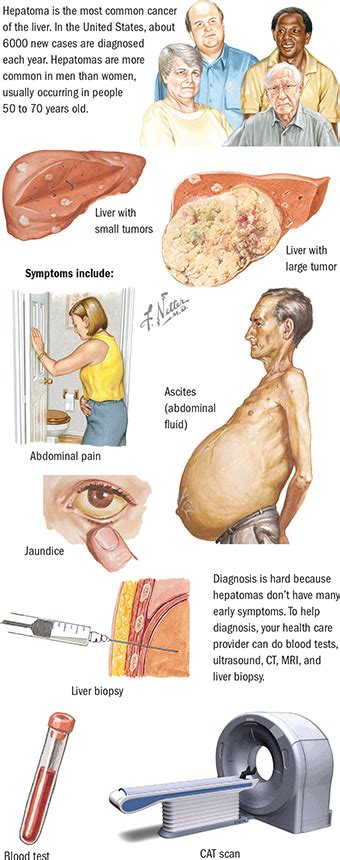 Liver Cancer Symptoms Causes And Treatment Scientific Animations Images