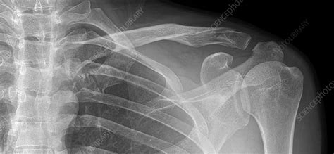 Fractured Collar Bone X Ray Stock Image C0540302 Science Photo