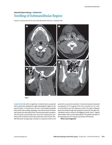 Swelling Of Submandibular Region Otolaryngology Jama Otolaryngology