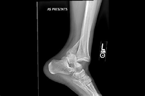 Ortho Dx How Would You Treat This Ankle Fracture Dislocation