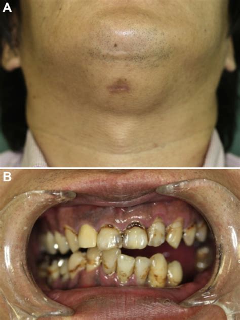 A Extraoral Examination Revealed Swelling Of The Submental Region