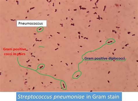Pneumococcus In Gram Stain Showing Gram Positive Diplococci Universe84a