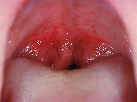 If you felt a bump, then you're part of a small percentage of the population who has one. Red Painful Patch On Roof Of Mouth - 12.300 About Roof