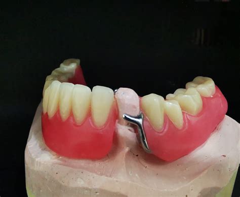 Protesis Dentales Clínica Rocamora