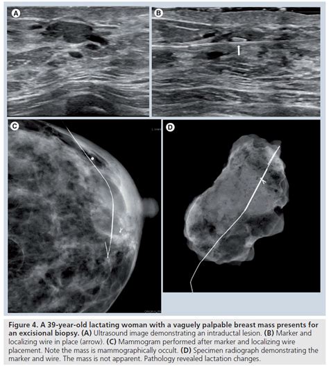 Image Guided Percutaneous Breast Biopsies