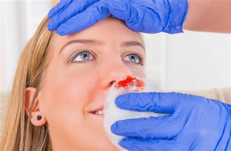 What Is A Nose Cauterization With Pictures