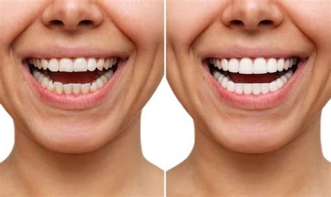 The Perfect Smile Solution Unveiling The Power Of Veneers
