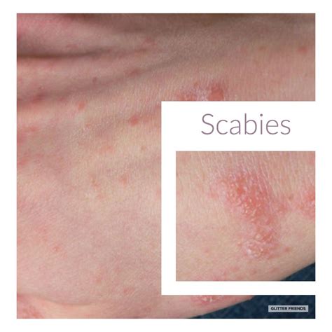 scabies mites on humans