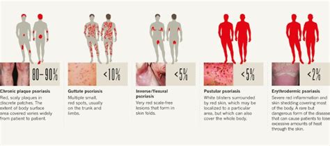 Types Of Psoriasis Pictures Guttate Psoriasis Pictures Pustular