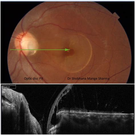 Optic Disc Pit Oct Image American Academy Of Ophthalmology