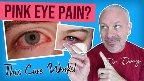 Pink Eye Cure Youtube