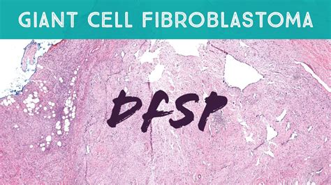 Dermatofibrosarcoma Protuberans With Giant Cell Fibroblastoma Pattern
