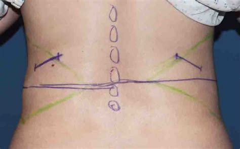 Rib Removal For Waistline Reduction Preoperative Markings Dr Barry